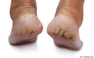 10 cách giúp trị nứt gót chân ngay tại nhà rất hiệu quả